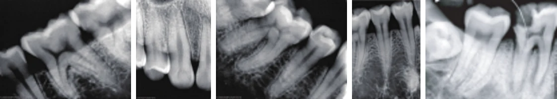 Radiografias periapicais em alta definição feitas com o Evo-T